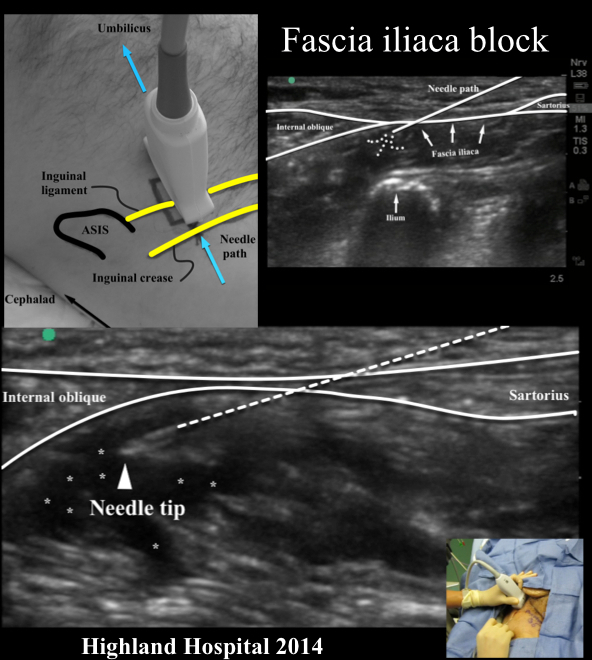Fascia iliaca compartment block: probe positioning, landmarks (ASIS, inguinal ligament), and ultrasound showing fascia iliaca, internal oblique, sartorius, and ilium
